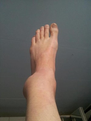 De enkel van pechvogel Jim Quant